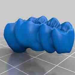 dental bridges on implants