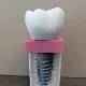 Scanbody for Dentist Implant Entertainment model